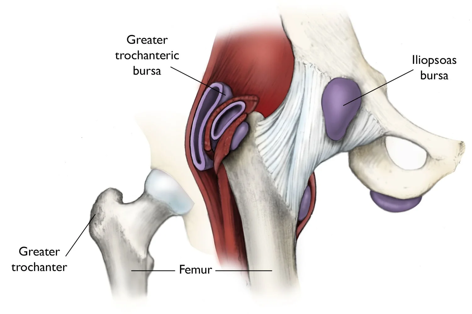 From Trochanteric Bursitis to Gluteal Tendinopathy